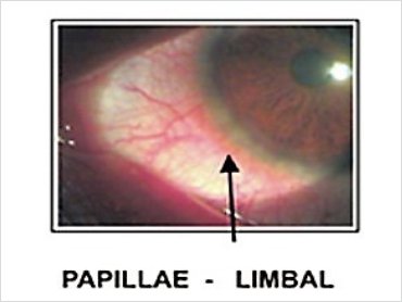 Corneal Abscess